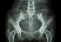 Film X-ray of Pelvis