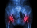 Film x-ray pelvis of osteoporosis patient and arthritis both hip Royalty Free Stock Photo