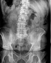 Film x ray or radiograph of an adult lumbar vertebrae anterior posterior AP view showing a very large osteophyte bone spur on L4