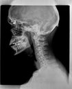 Film x ray or radiograph of a cervical neck. Lateral side view showing straightening or slight kyphosis normally seen after a