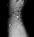 Film x ray or radiograph of a lumbar vertebrae anterior posterior AP slightly oblique view showing Scotty dog sign, a bone