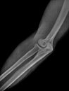 Film x ray or radiograph of a normal adult elbow. Lateral oblique view showing normal bone structure of humerus, radius and ulna