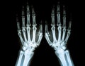 Film X-ray of Rheumatoid arthritis hand shows joint space narrowing of hand . Rheumatoid arthritis patient 's hand in x-ray. Royalty Free Stock Photo