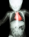 Film x-ray whole child's body with heart disease ( Rheumatic heart disease , Valvular heart disease ) ( Cardiovascular system )