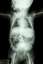 Film x-ray whole infant's body