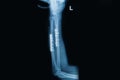 Film x-ray wrist fracture : fracture radius and ulnar