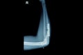 Film x-ray wrist fracture : show fracture radius bone