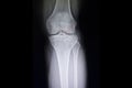 Fracture tibial spine film