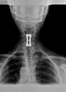 Film xray or radiograph of a cervical neck. AP anterior posterior view showing surgical bracket to help stabilize the patients Royalty Free Stock Photo