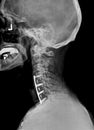 Film xray or radiograph of a cervical neck. Lateral side view showing surgical bracket to help stabilize the patients neck