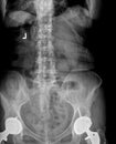 Film xray or radiograph of a lumbar spine, pelvis and hip. AP anterior posterior view showing bilateral hip replacement surgery