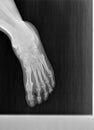 Film xray or radiograph of a normal foot, ankle and leg. dorsal anterior posterior view showing normal bone structure. joint space