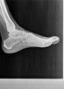Film xray or radiograph of a normal foot, ankle and leg. Lateral view show normal bone structure of joint space is normal
