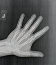 Film xray or radiograph of a normal left hand of an adult male. AP view show humans hand. normal bone structure of all phalanges Royalty Free Stock Photo