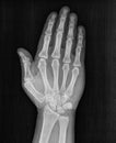 Film xray x-ray or radiograph of a hand and fingers showing ban, stop, halt, forbidden, no trespassing in gestural language,