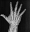 Film xray x-ray or radiograph of a hand and fingers showing the number five 5 in gestural language, manual communication, or Royalty Free Stock Photo