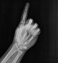 Film xray x-ray or radiograph of a hand and fingers showing the number one 1 in gestural language, manual communication, or