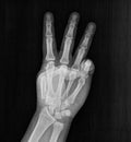 Film xray x-ray or radiograph of a hand and fingers showing the number three 3 in gestural language, manual communication, or Royalty Free Stock Photo