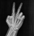 Film xray x-ray or radiograph of a hand and fingers showing the number two 2 in gestural language, manual communication, or Royalty Free Stock Photo