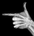 Film xray x-ray or radiograph of a thumb and finger in gestural language, manual communication, or signing aka sign language,