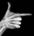 Film xray x-ray or radiograph of a thumb and finger in gestural language, manual communication, or signing aka sign language,