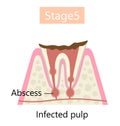 the final stage of tooth decay, abscess formation. Dental and oral health care concept