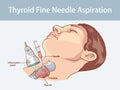 Fine Needle Aspiration of Thyroid Nodules