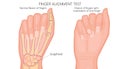 Finger alignment test. Broken finger. Vector illustranion Royalty Free Stock Photo