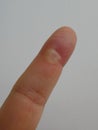 Finger with burn on the skin from injured