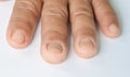Finger, and fungus in the nail