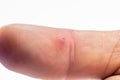 Finger with infection from wood splinter Royalty Free Stock Photo