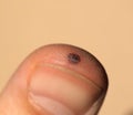 finger injury following hammer blow