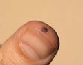 finger injury following hammer blow