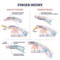 Finger injury types with common hand impact trauma anatomy outline diagram