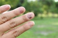 Finger with onychomycosis. A toenail fungus.. - soft focus