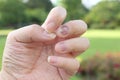 Finger with onychomycosis. A toenail fungus.. - soft focus