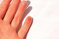 A finger stung by a bee. Female hand with an insect bite,  on white background, copy space. Royalty Free Stock Photo