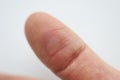 On finger there is red callus and an abscess