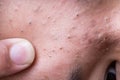 Finger on ugly pimples blackheads on face of teenager