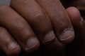 Fingers of Black Person With Diseased Nails and Cuticles Royalty Free Stock Photo