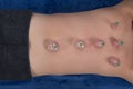 Fire cupping cups on back of male patient