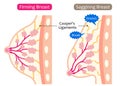 Firm and sagging breasts illustration. womenÃ¢â¬â¢s beauty body care concept