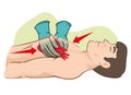 First Aid cardiac resuscitation CPR, open heart massage