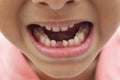 First baby teeth out toothless smile Royalty Free Stock Photo