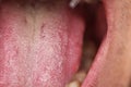 First sign of coronovirus, protruding white plaque on tongue, closeup