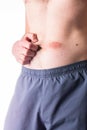 The first signs of psoriasis or another skin disease