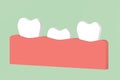 First tooth, tooth growing up from gum and between other teeth