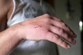 Fish Hook Embedded into skin of Man`s Hand