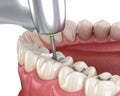 Fissure Preparation for fillings placement, Medically accurate 3D illustration of dental concept