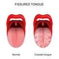 Fissured tongue. Healthy and cracked tongue